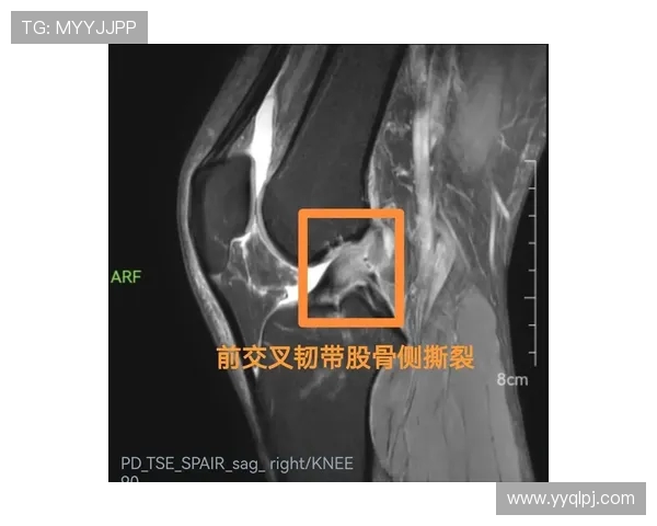 利物浦后卫莱奥尼遭遇前交叉韧带撕裂伤势将缺席数月